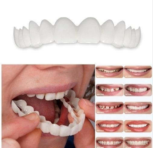 Facetas Odontológicas Removíveis - Prótese Superior e Prótese Inferior